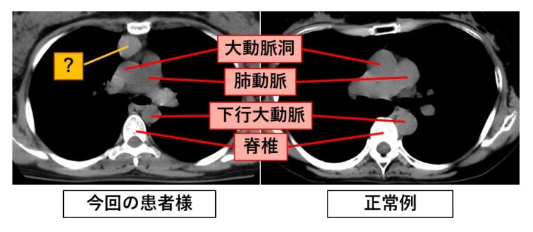 胸腺腫 Thymoma|新大阪画像の森診断クリニック|大阪の画像診断専門クリニック