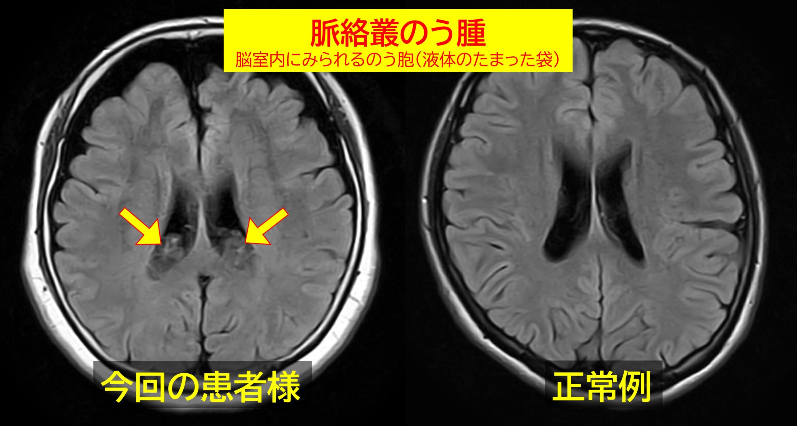 MRIで見る脈絡叢のう腫