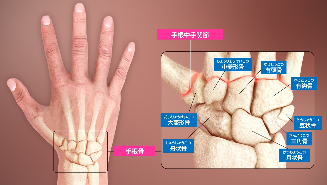 舟状骨骨折 Scaphoid Fracture|新大阪画像の森診断クリニック|MRI・CT画像診断クリニック