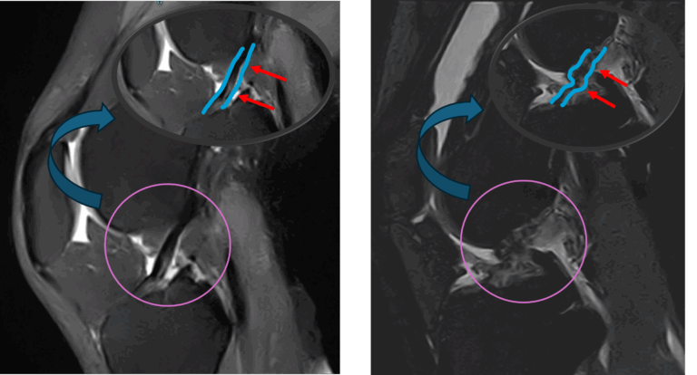 前十字靭帯損傷 Anterior Cruciate Ligament Injury|新大阪画像の森診断クリニック|MRI・CT画像診断クリニック
