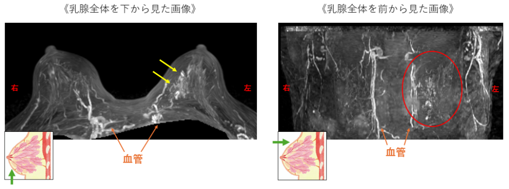 【乳腺全体を下・前から見た画像】