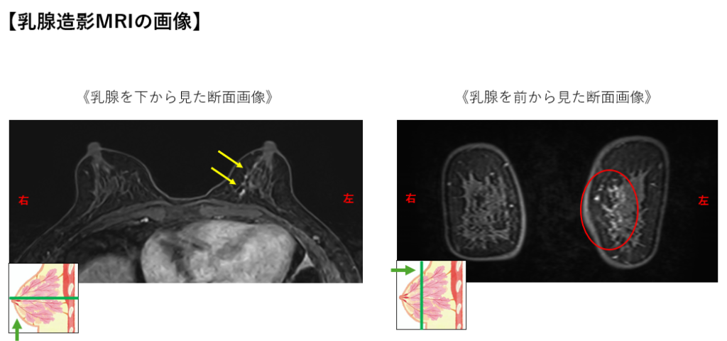 【乳腺造影MRIの画像】
