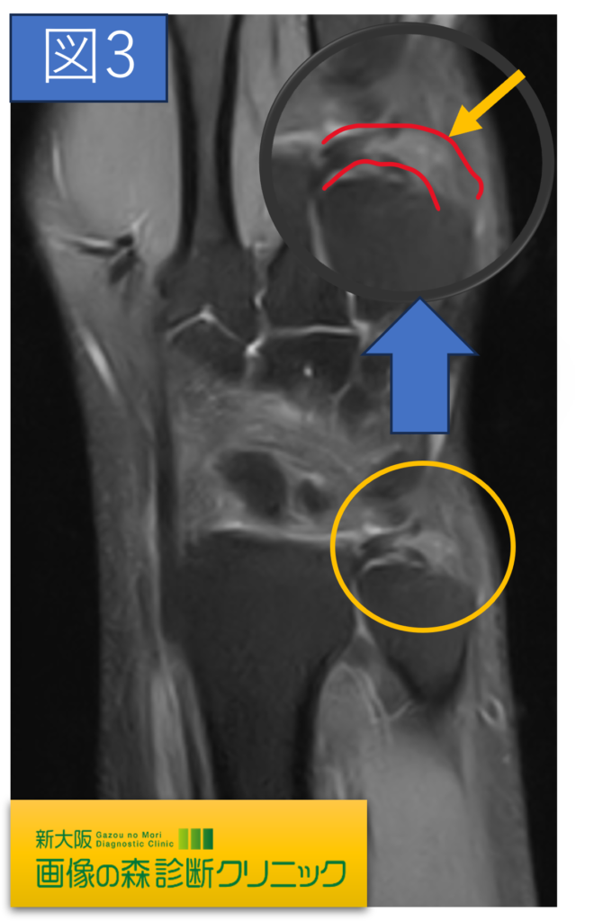 正常MRI画像（矢状断像）