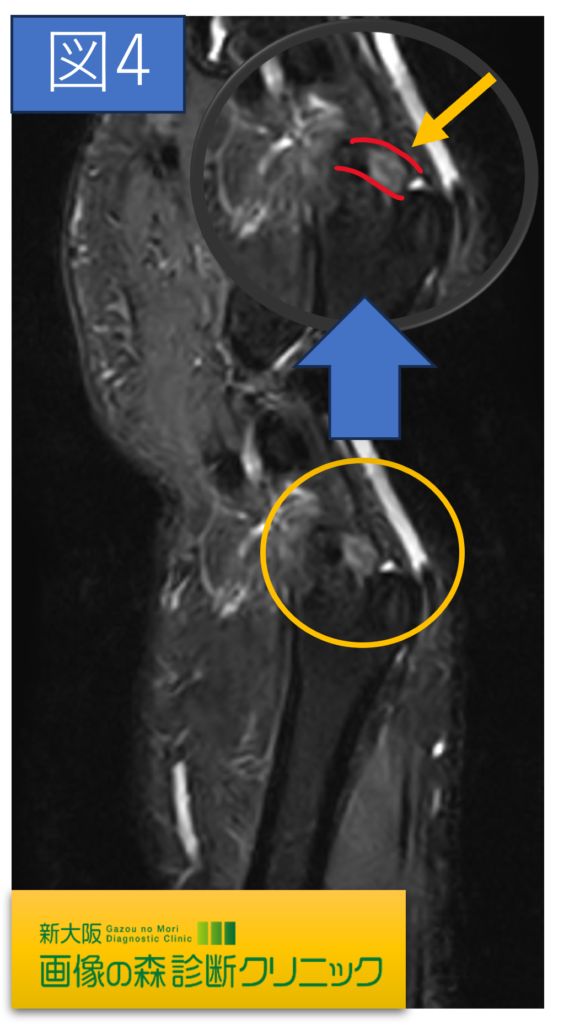 TFCC損傷MRI画像（矢状断像）