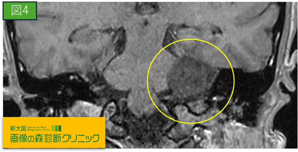 聴器MRI画像（冠状断像）