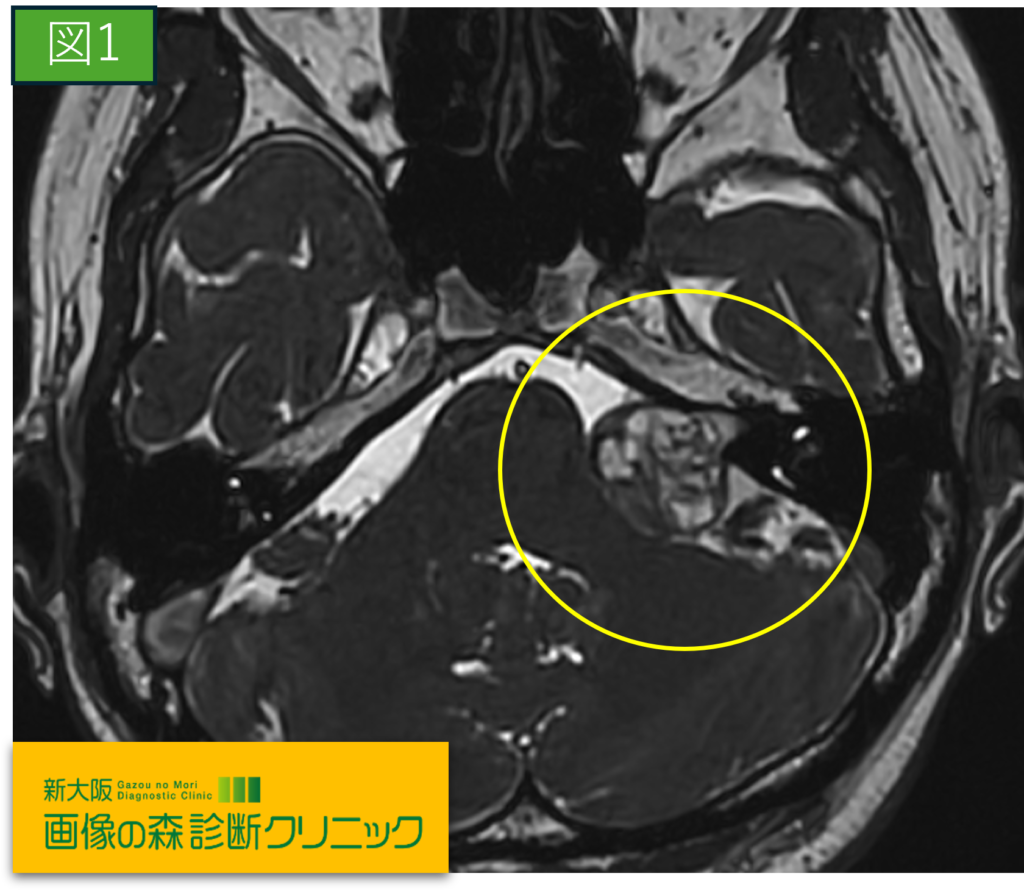 聴器MRI画像（横断像）