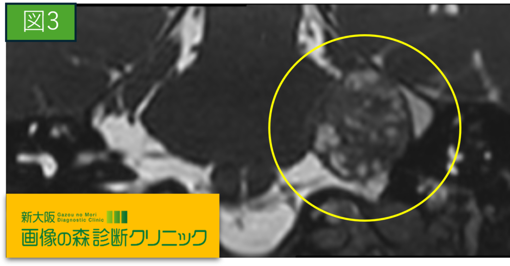 聴器MRI画像（冠状断像）