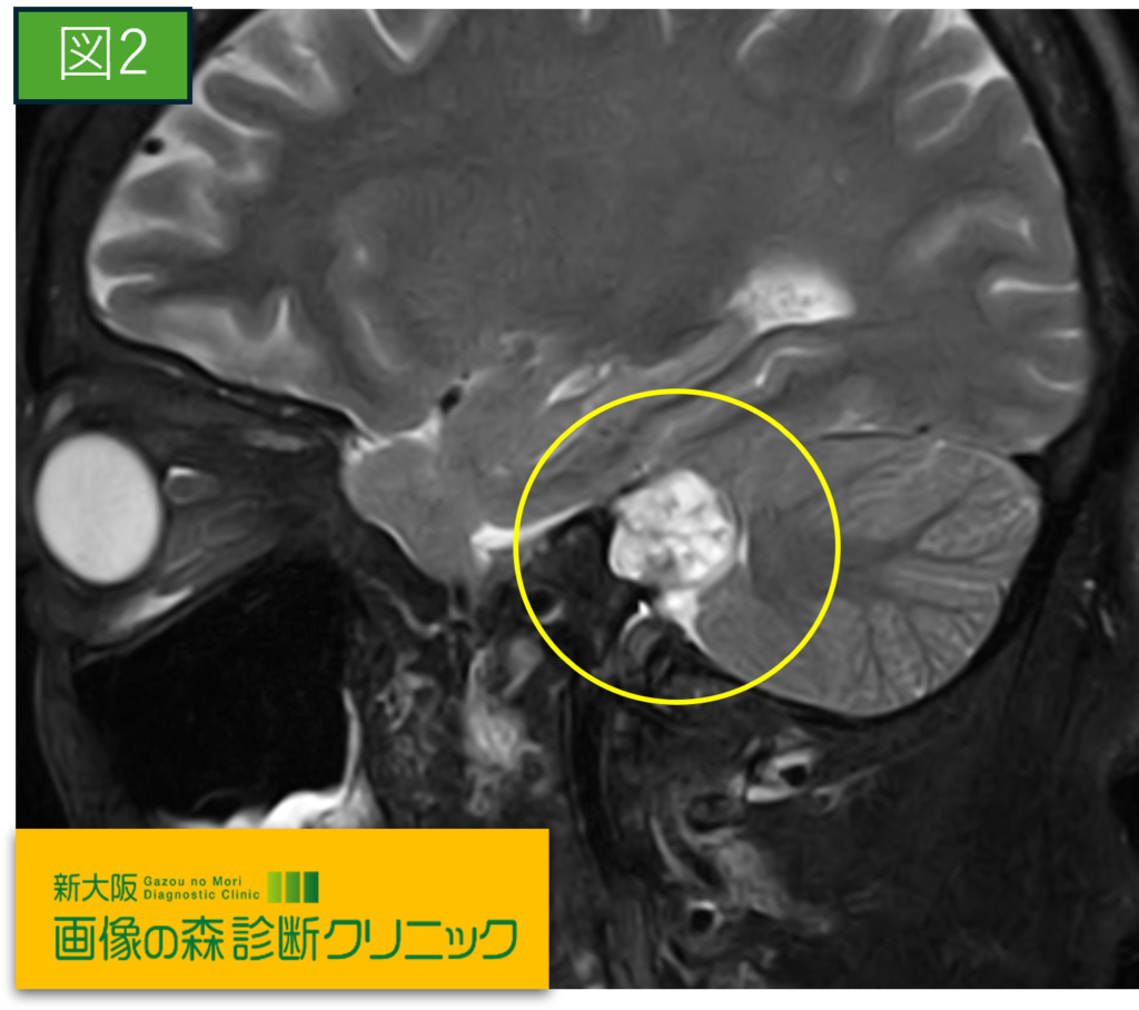 聴器MRI画像（矢断像）