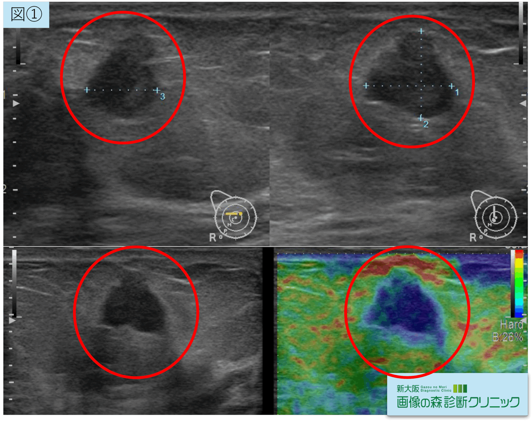 MRI、エコー検査で見つかった乳がん|新大阪画像の森診断クリニック|MRI・CT画像診断クリニック