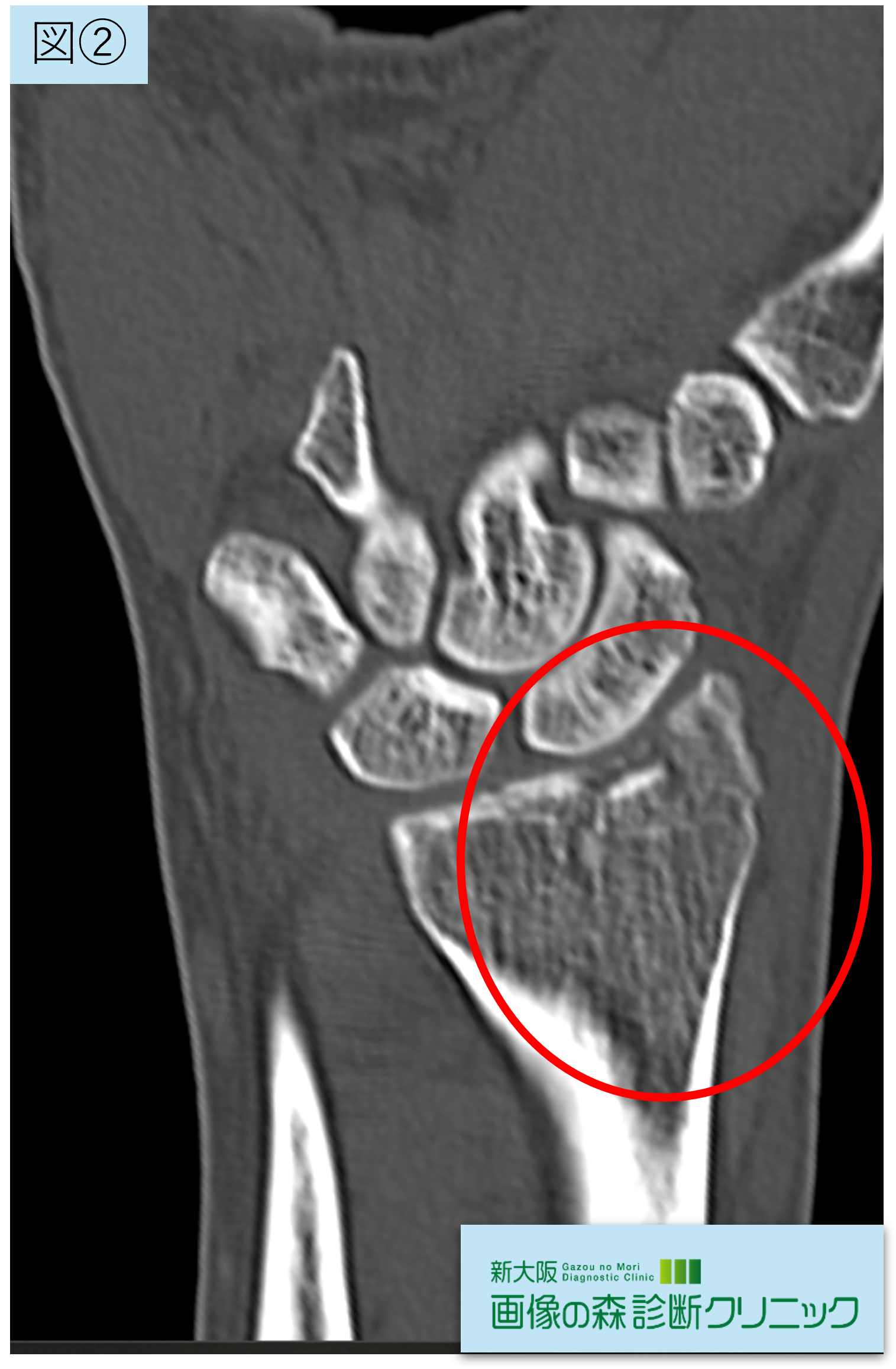 CT画像 冠状断像 図2