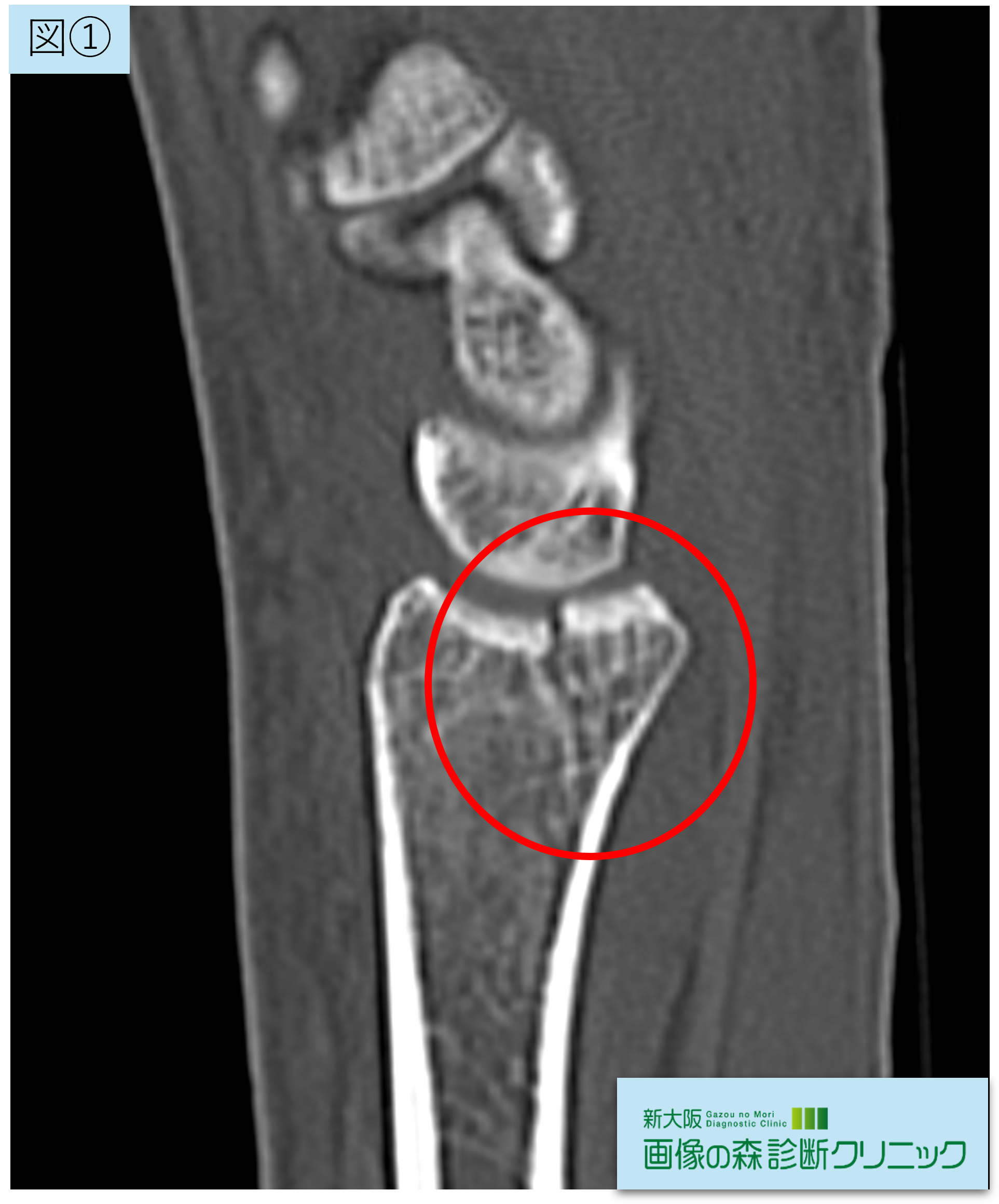 CT画像 矢状断像 図1