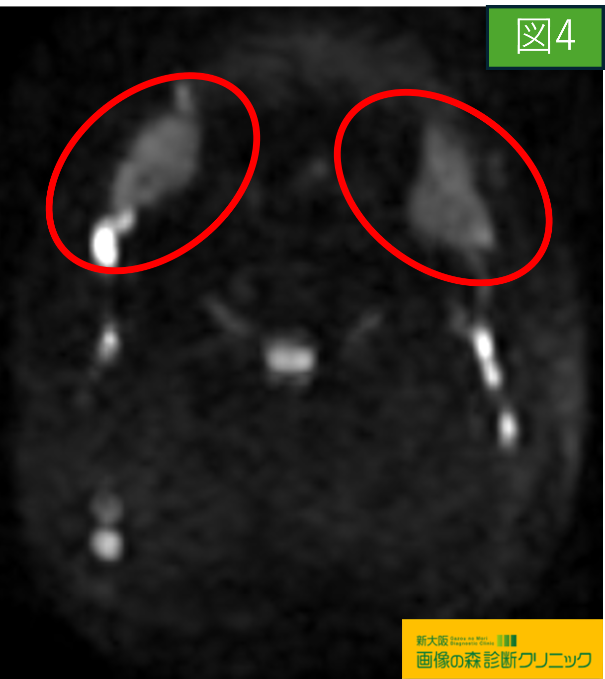 頚部MRI DWI画像 正常顎下腺 図4