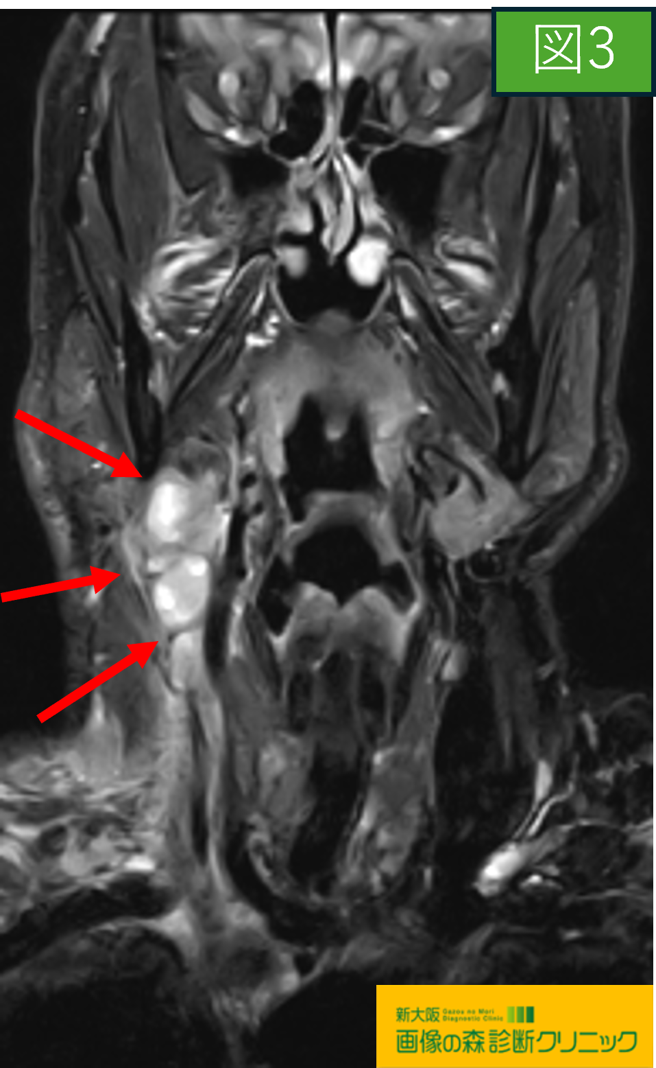 頚部MRI STIR画像 顎下腺腫瘍 図3
