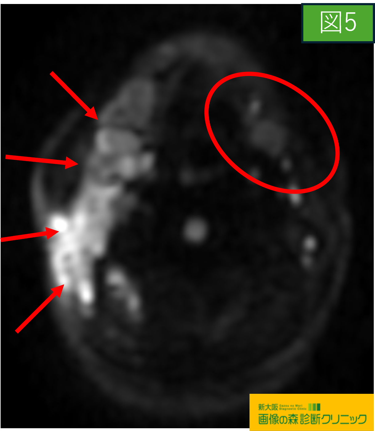 頚部MRI DWI画像 顎下腺腫瘍 図5