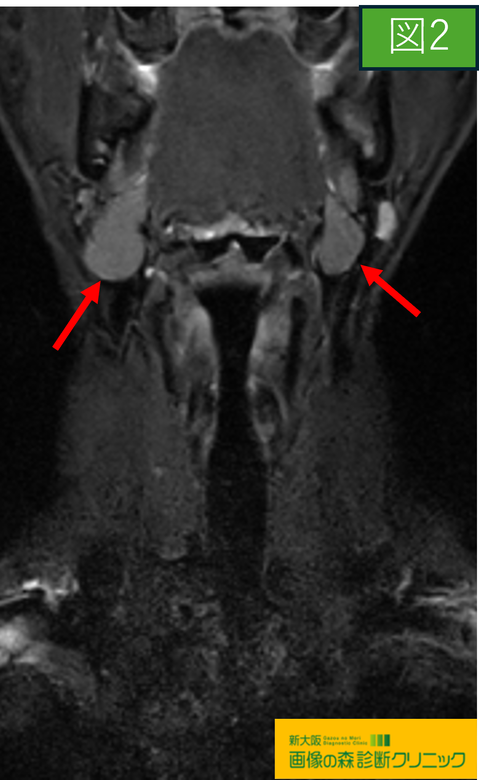頚部MRI STIR画像 正常顎下腺 図2