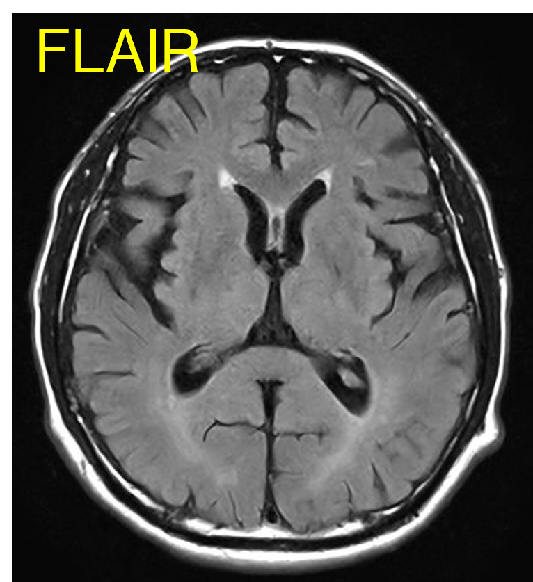 FLAIR