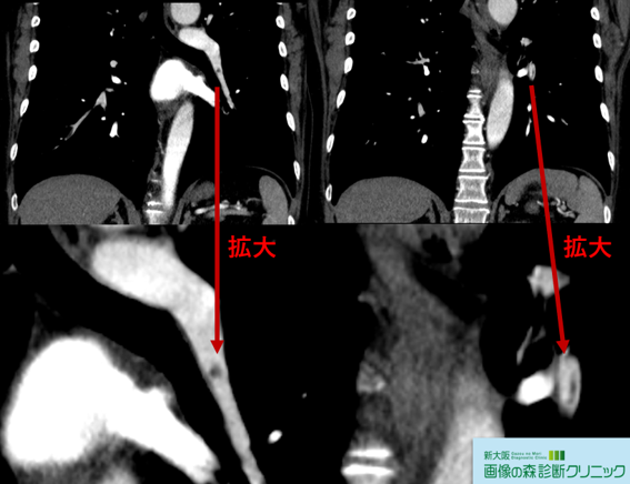 造影CT 肺動脈血栓 冠状断像