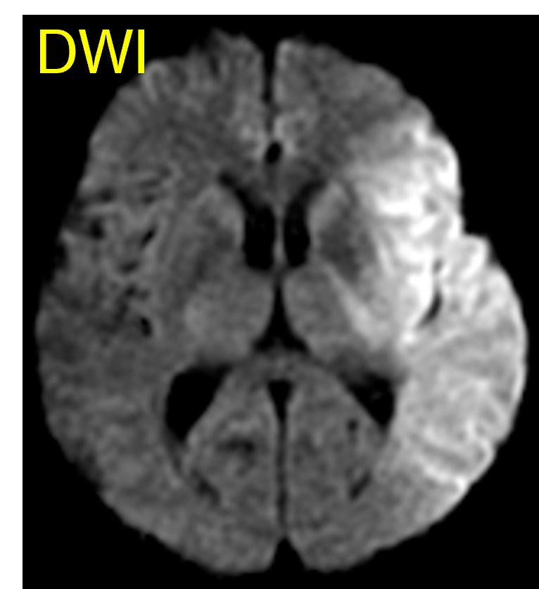 DWI