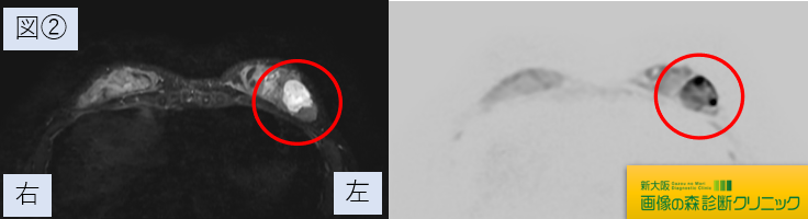乳腺腫瘍 MRI画像 図2