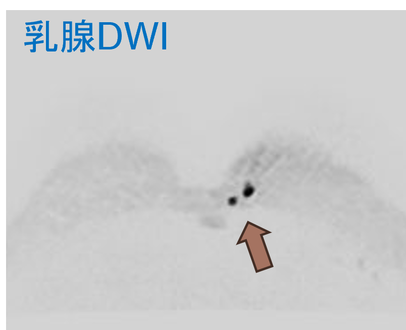 乳腺DWI