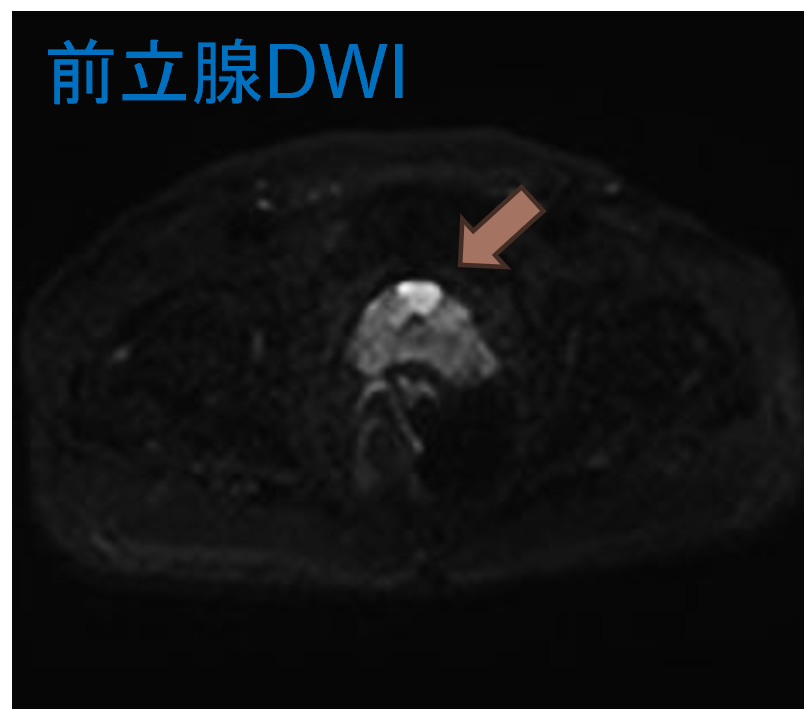 前立腺DWI