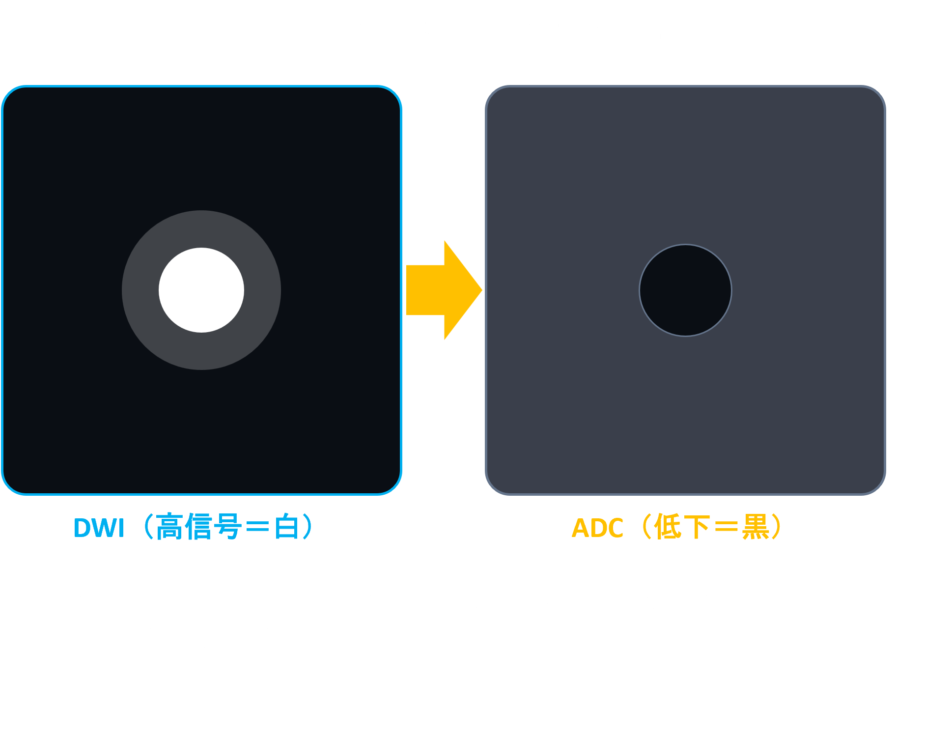 DWI高信号とADC低信号の比較