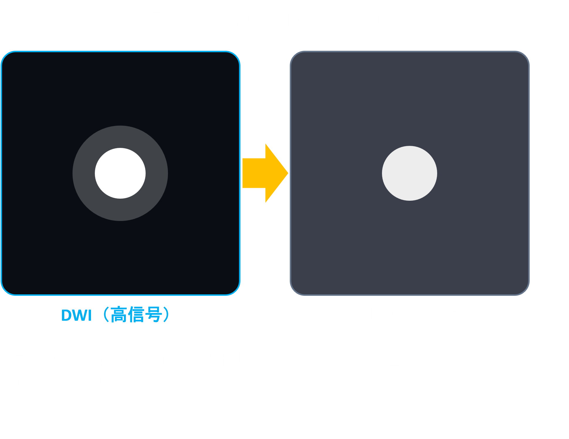 DWI高信号とADC高信号の比較