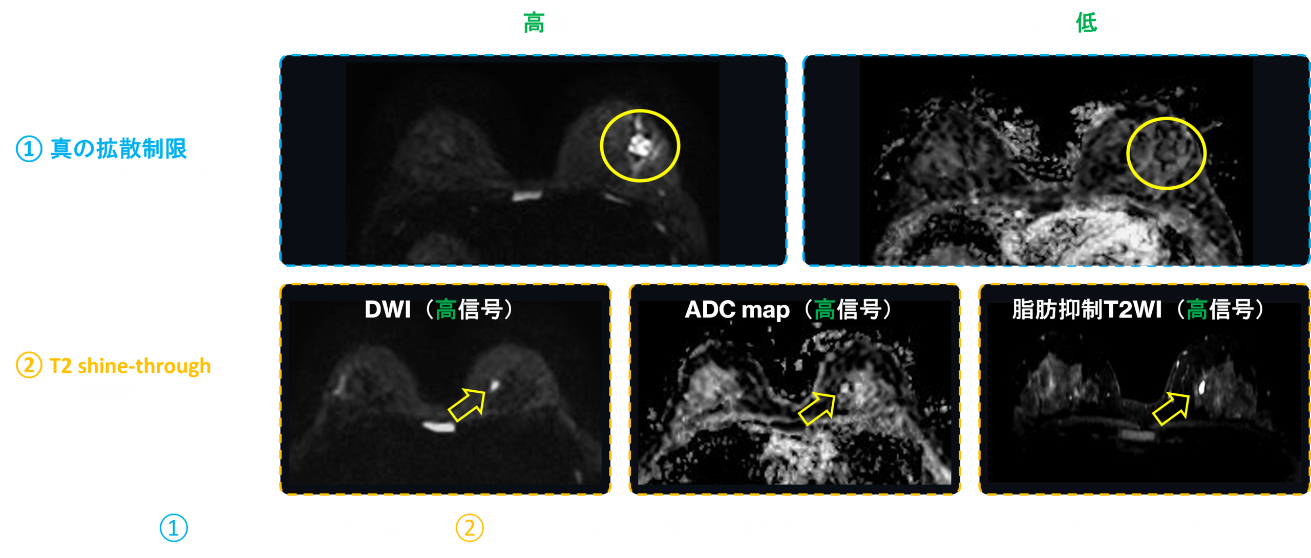 乳がんと乳腺嚢胞のDWI・ADC比較