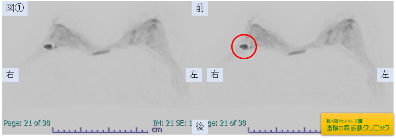 ドック受診時の乳腺MRI画像