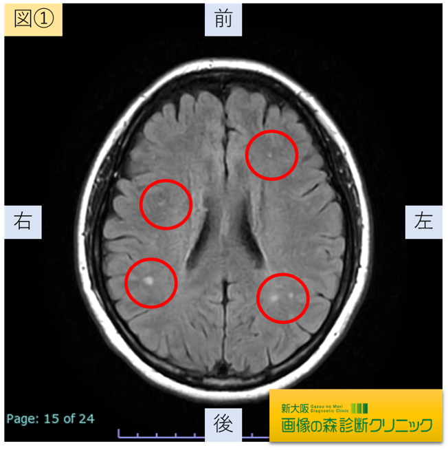 脳MRI