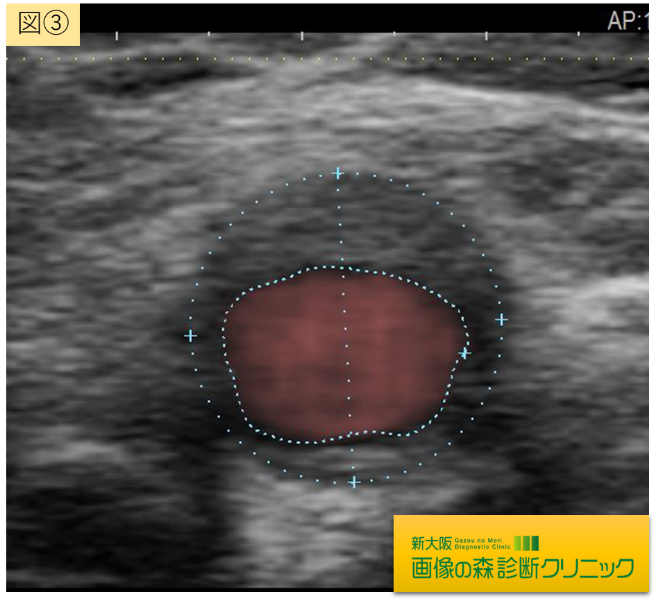頸動脈エコー画像 図3
