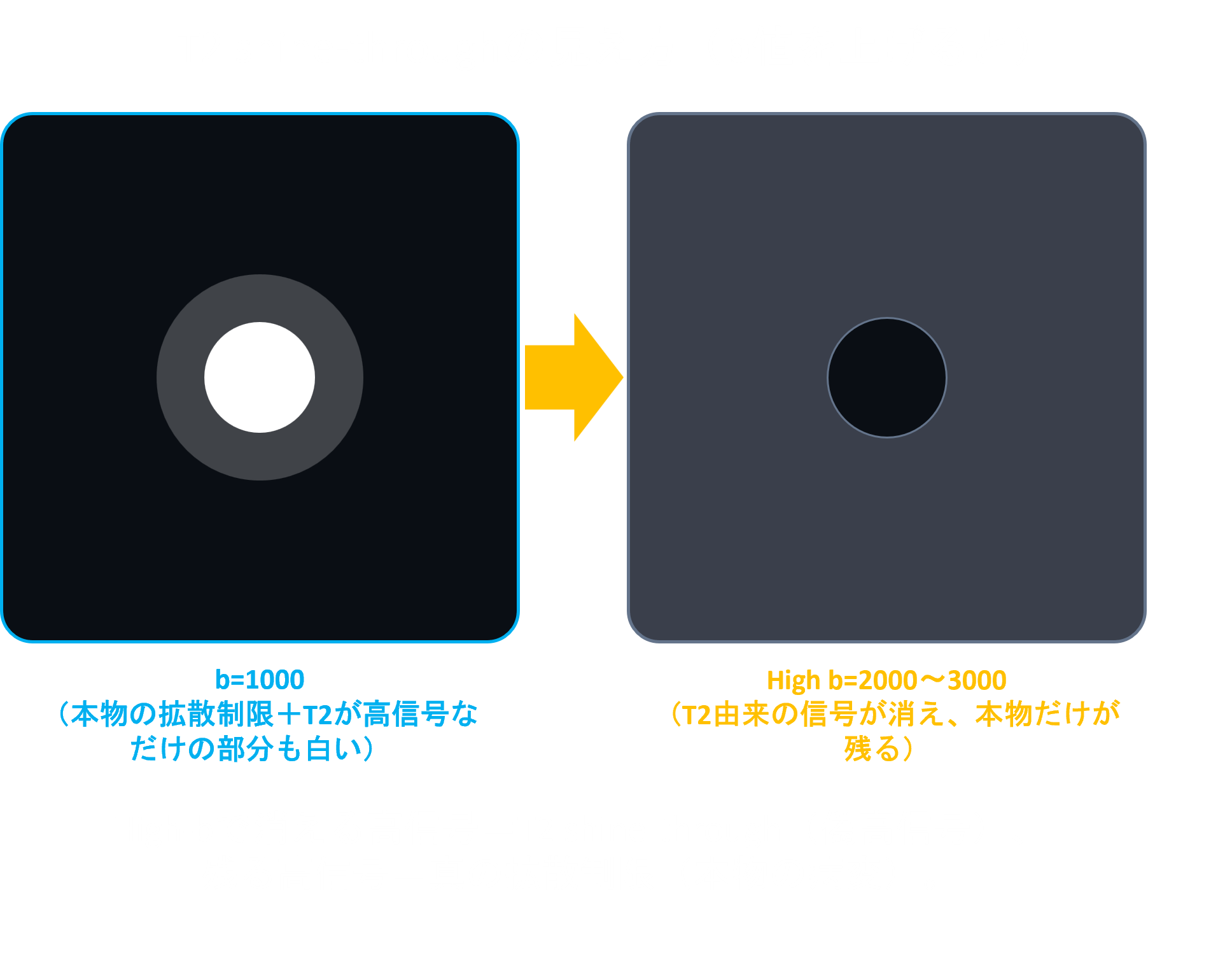 High b値とT2 shine-throughの関係を示した模式図