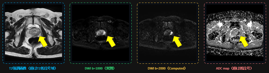 前立腺MRIのT2強調画像、DWI b=1000、Computed DWI b=2000、ADC mapの4枚比較画像