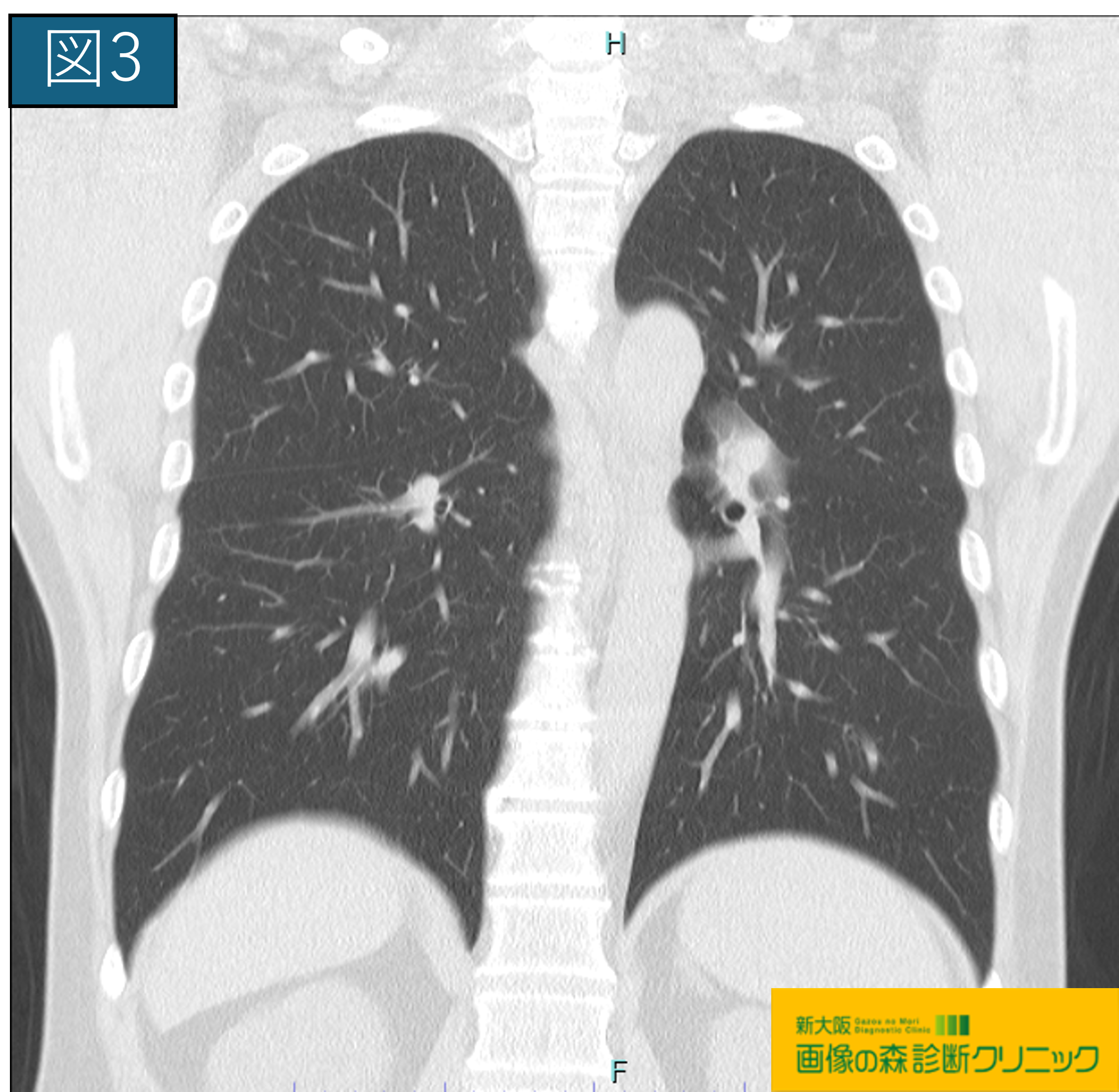 図3 正常な肺のCT冠状断像